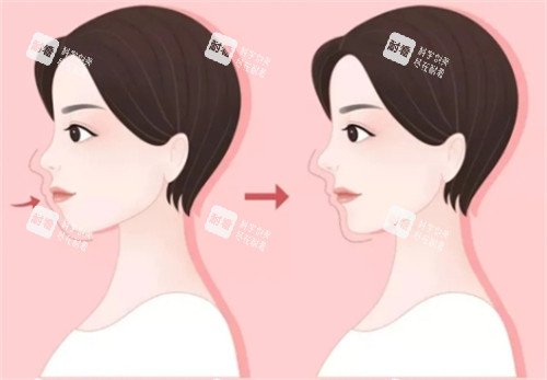 如何分辨自己是不是凸嘴