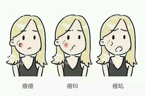 痘印痘坑卡通图.jpg