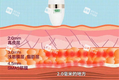超声炮层次.jpg 超声炮层次.jpg