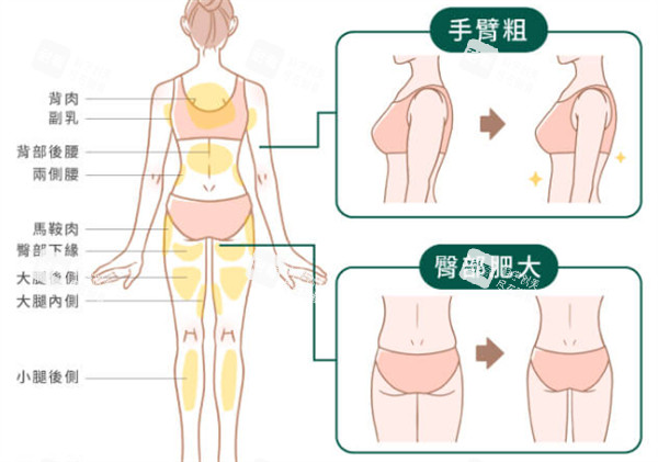 吸脂部位解析