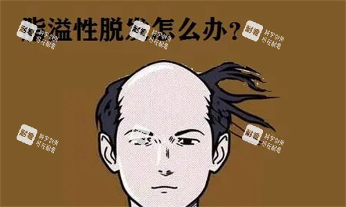 脂溢性脱发怎么办