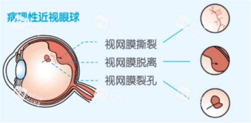 视网膜问题 视网膜问题