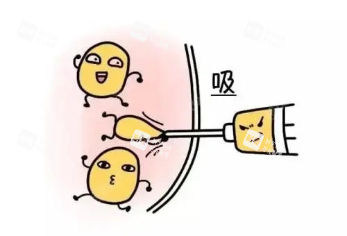 抽脂漫画示意图 抽脂漫画示意图