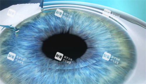 近视手术前眼睛制瓣.jpg 近视手术前眼睛制瓣.jpg
