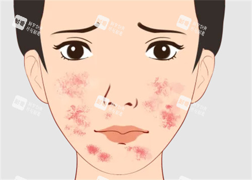 痘印治疗方法 痘印治疗方法