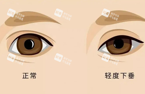 上睑轻度下垂和正常眼对比示意图 上睑轻度下垂和正常眼对比示意图
