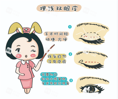 埋线双眼皮