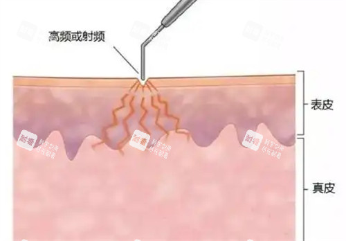 激光去疤原理 激光去疤原理