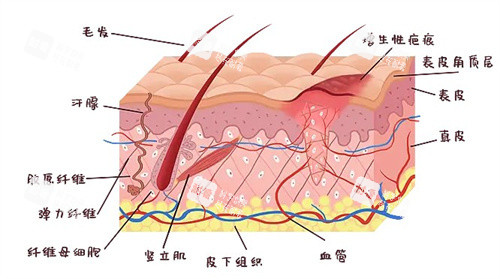 增生疤痕是怎么形成的 增生疤痕是怎么形成的