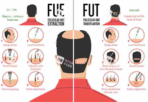 FUE和FUT对比图 FUE和FUT对比图