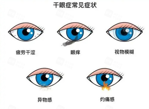 干眼症常见症状 干眼症常见症状