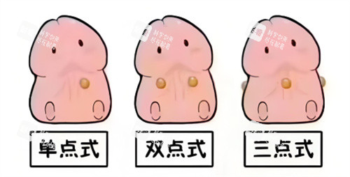 入珠手术动画