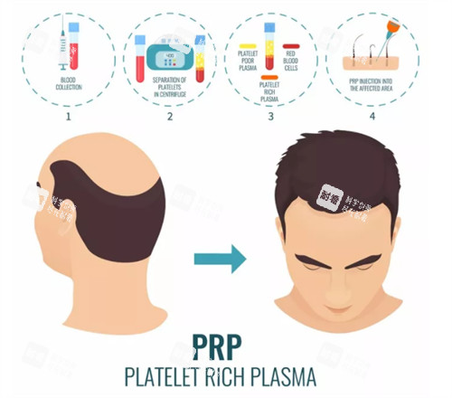 脱发PRP注射治疗前后对比图 脱发PRP注射治疗前后对比图