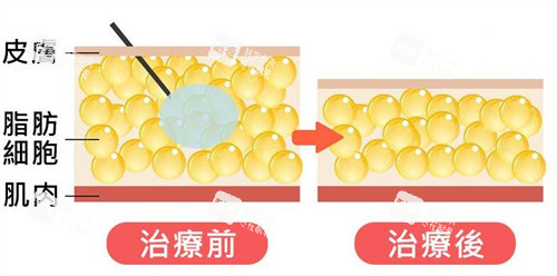 注射溶脂原理卡通图展示