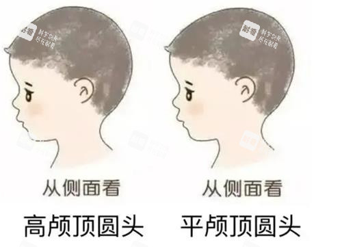 高颅顶和正常头的对比 高颅顶和正常头的对比