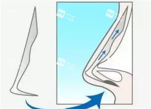 鼻假体 鼻假体