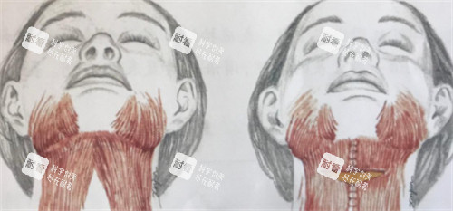 颈阔肌成形术怎么做.jpg 颈阔肌成形术怎么做.jpg