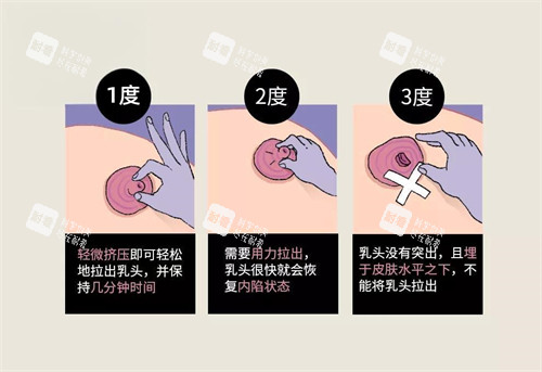 乳头内陷按摩方式图 乳头内陷按摩方式图