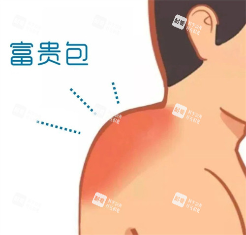 富贵包在身体的位置.jpg 富贵包在身体的位置.jpg