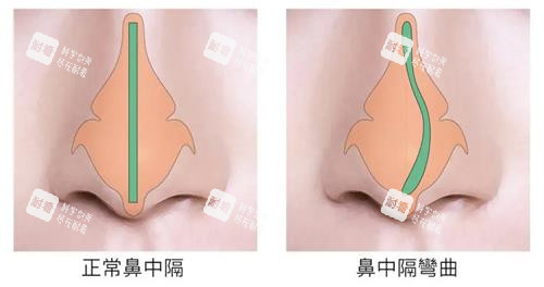 鼻中隔偏曲和正常鼻子的对比 鼻中隔偏曲和正常鼻子的对比