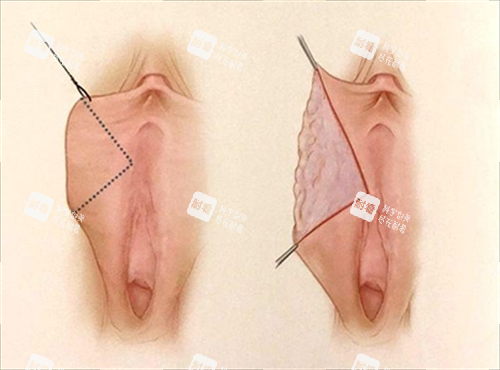 女性私密手术动画展示