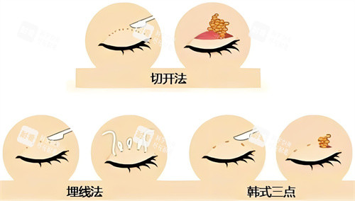 双眼皮方法对比图 双眼皮方法对比图