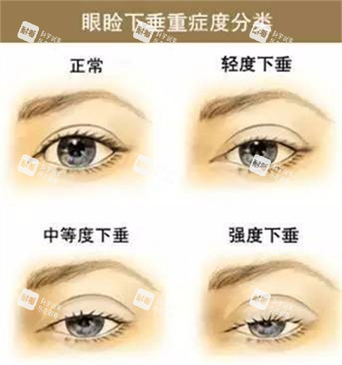 眼睑下垂程度 眼睑下垂程度
