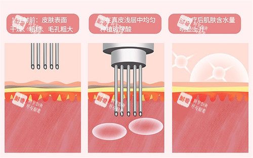 水光前后皮肤对比
