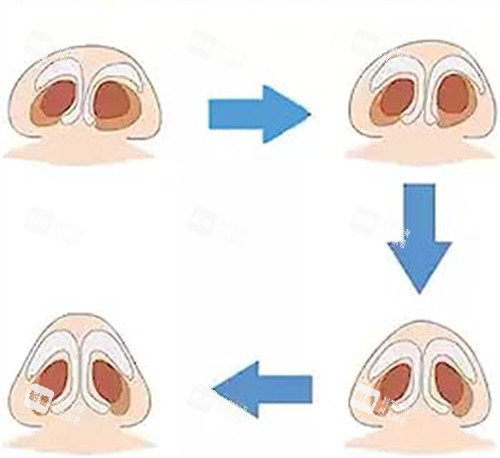 歪鼻