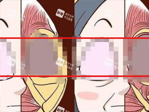 玻尿酸栓塞组织对比动画.png