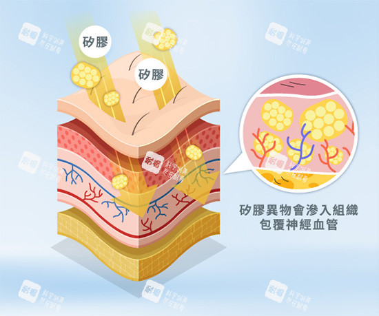 馒化针注射示意图 馒化针注射示意图