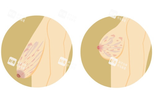 胸部下垂手术前后示意图.jpg