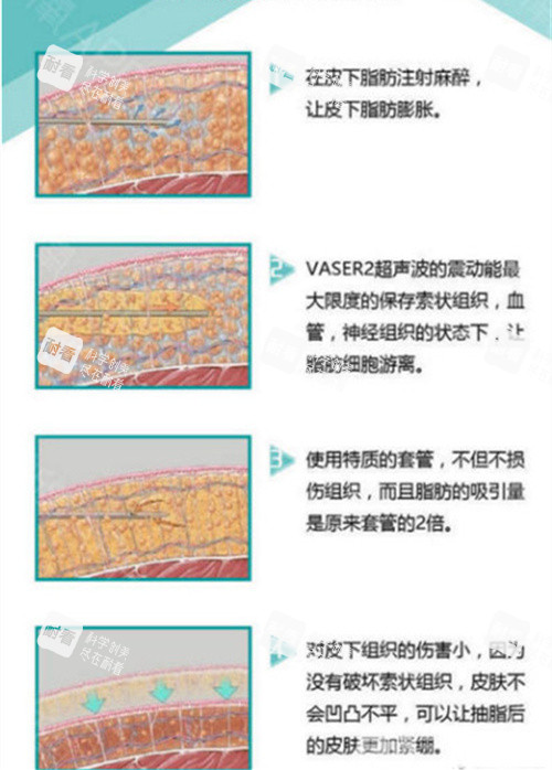 威塑手术机器与手术方式演示动画图.jpg 威塑手术机器与手术方式演示动画图.jpg