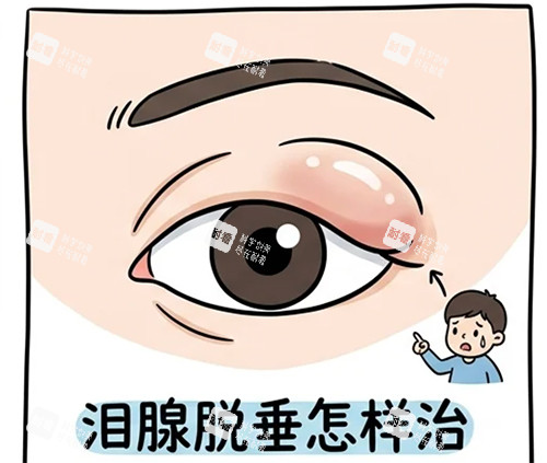 泪腺脱垂怎么治.jpg 泪腺脱垂怎么治.jpg
