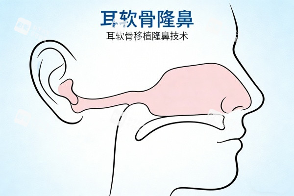 耳软骨隆鼻卡通图一览 耳软骨隆鼻卡通图一览