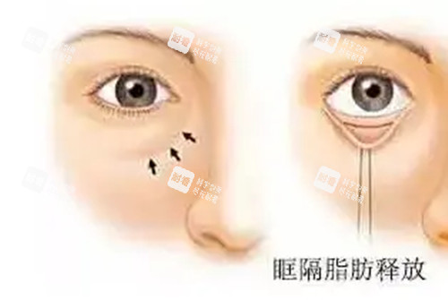 内切法眶隔脂肪释放