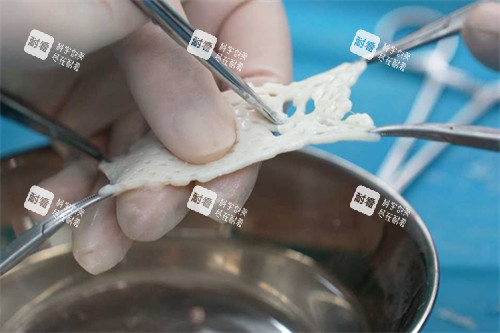 AMD生物补片图示.jpg AMD生物补片图示.jpg