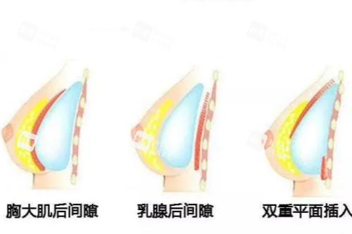 假体隆胸植入位置示意图.jpg