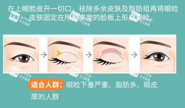 全切双眼皮解析 全切双眼皮解析