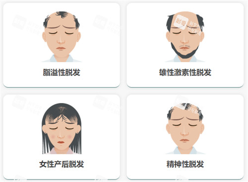 不同脱发类型
