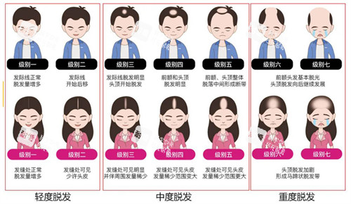 不同程度的脂溢性脱发