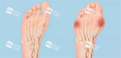 正常脚和大脚骨.jpg 正常脚和大脚骨.jpg