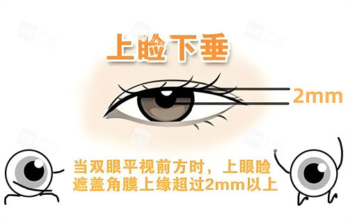 判断是否上睑下垂图示.jpg 判断是否上睑下垂图示.jpg