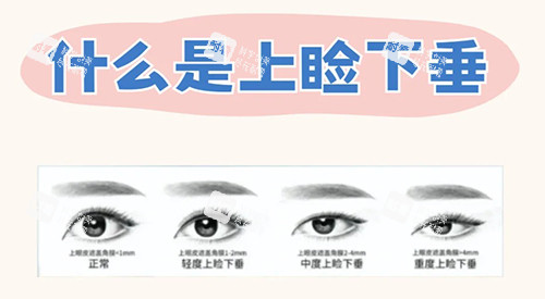 什么是上睑下垂.jpg 什么是上睑下垂.jpg