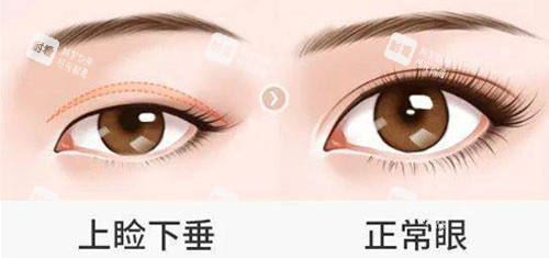 上睑下垂手术.jpg 上睑下垂手术.jpg