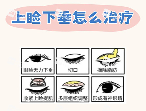 上睑下垂治疗漫画图.jpg 上睑下垂治疗漫画图.jpg