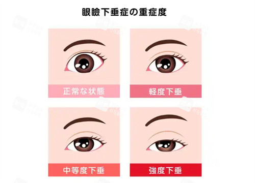 上睑下垂不同程度的样子.jpg 上睑下垂不同程度的样子.jpg