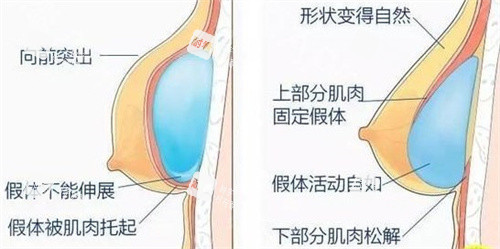 内窥镜隆胸.jpg