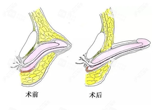 男性私密整形阴茎增长手术示意图