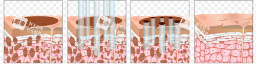 激光祛斑前后皮肤的对比.jpg 激光祛斑前后皮肤的对比.jpg